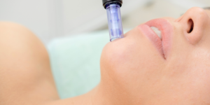 Microneedling