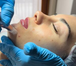 Microneedling e nanoneedling a Cuneo: rigenera la pelle a settembre