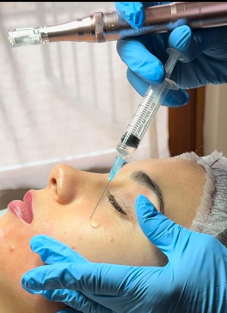 microneedling Cuneo